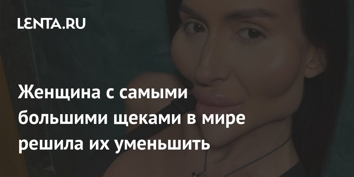 Модель с самыми большими щеками в мире решила их уменьшить спустя 10 лет инъекций Модель с самыми большими щеками в мире решила их уменьшить спустя 10 лет инъекций
