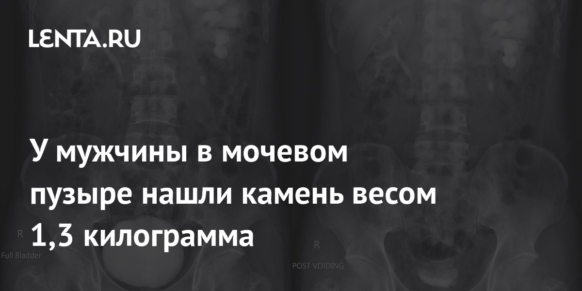 Китайский фермер три года терпел боль: в мочевом пузыре нашли камень весом 1,3 кг Китайский фермер три года терпел боль: в мочевом пузыре нашли камень весом 1,3 кг