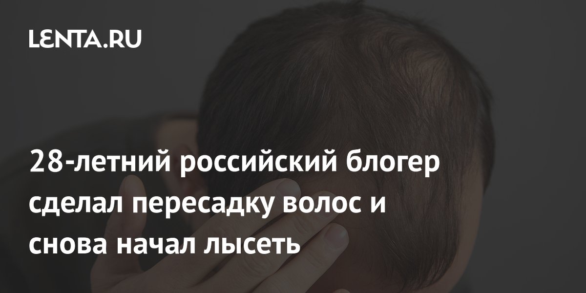 Российский блогер Братишкин рассказал о рецидиве облысения после пересадки волос