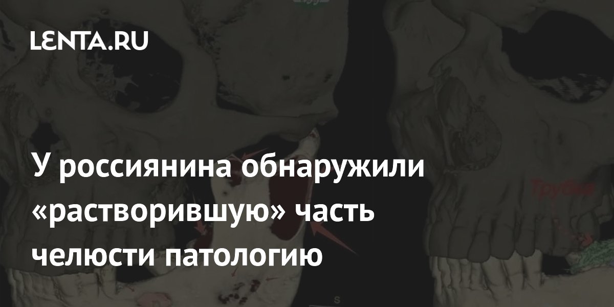 У россиянина обнаружили кисту, растворившую часть челюсти